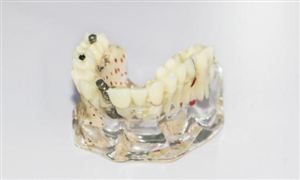 種植牙行業(yè)市場深度分析及發(fā)展趨勢預(yù)測報告2023